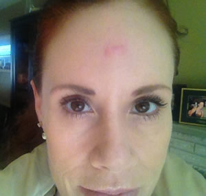 Post procedure on forehead, almost healed